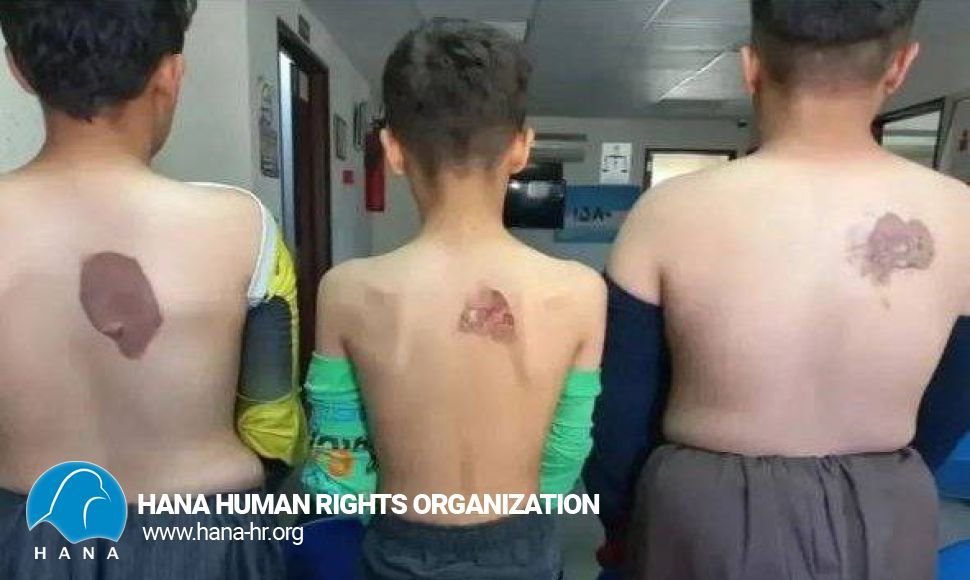 Three child laborers were burned with an iron by their employer
